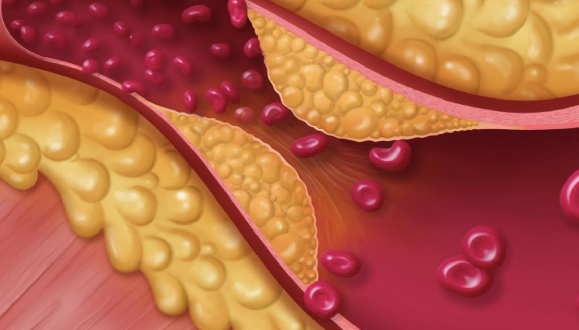 Colesterol y Trigliceridos