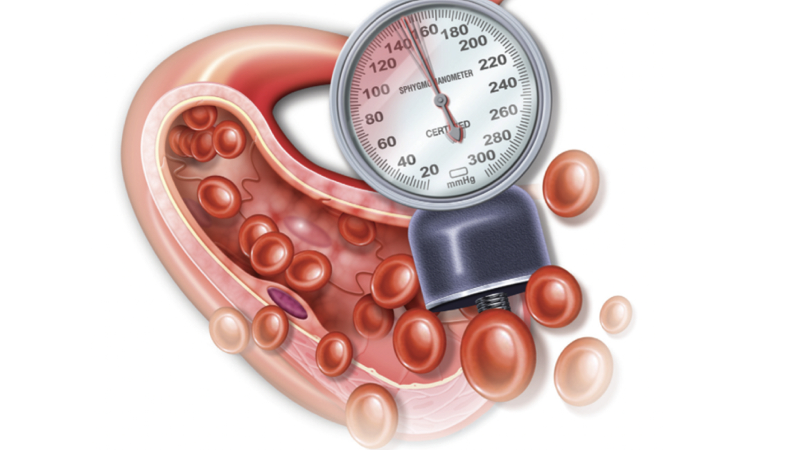 hipertensión arterial